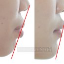 e스마일치과기공소 | 아래 앞니 결손과 잇몸돌출, 거미스마일 개선 후기. 심미선 분석