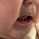 신성메디칼 | 4개월 단설소대수술, 애매한 설소대 후기(단설소대수술병원 찾는 꿀팁)