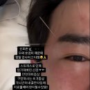 안면가스 이미지