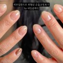 손톱공주 - 거제시 | 손톱무좀이 아니에요! 피부질환으로 인해 변형된손톱 손톱복구후기 대전문제성손톱교정