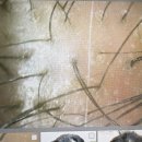 알알 탈모두피 연구소(ALAL) | 목동40대 남성 유전탈모, 알알 두피 연구소 케어 후기 (3회차)