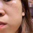 송정동 66-7 | [구미송정] 구미 송정동 기미잡티 제거 잘하는곳 메리뷰티 리얼후기 전후사진있음