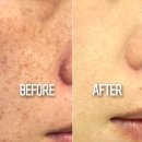 밝은약국 | 약국 기미크림 도미나 효과 + 잡티와 전쟁한 후기...ㅎ