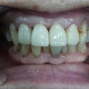 유디고촌치과의원 | 일산 임플란트 수술 후기 70대 앞니 임플란트. 감쪽같죠?