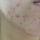 탑리약국 | 여드름 관련 연고 및 제품 비교해보기~!!