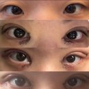 더페이스성형외과의원 | 윤진이 쌍꺼풀 수술 전&amp;후 후기