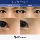 플로라성형외과의원 | 앞트임 복원후기 실패와 만족의 차이는 여기서 갈립니다