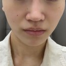 바늘스케치 | 압구정 힐로웨이브 전후 비교, 볼 패임 개선 효과 후기