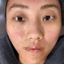 💉 인천. 구월동 여드름치료 전문 ‘해율한의원 인천점’ 율각테라피 치료 후기 !