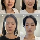 양재역 | 양재역 피부과 제오민 턱보톡스효과후기