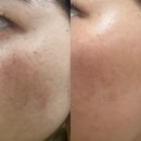 세븐일레븐 부산하단제일점 | [부산 하단 명지 후기] 기미잡티 레이저토닝 1회차 – 시술 전후 변화 공개!