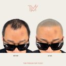 TMW 탈모왕수원 이미지