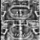 보스톤드림치과의원 | 의정부 보스톤미소치과, 상악 틀니와 하악 임플란트로 새 삶을 시작한 환자
