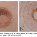 활동성 원형탈모증에서 병변 변연부 모낭의 아포프토시스 이미지