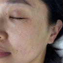 [수원 미작뷰티 후기] 출산 후 짙어진 기미, 드디어 관리 시작!