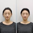 차한의원 | 안면비대칭한의원 교정 1회차 후기 (가격/전후사진 포함)