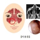 비용종[Nasal polyp]귀코목질환 이미지