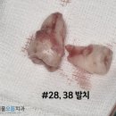 난곡으뜸치과의원 | 하남감일치과 "안 아픈 사랑니, 꼭 뽑아야 하나요?" 난케이스 매복 사랑니 발치 후기