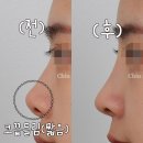 들창코 | 들창코수술 전후, 콧구멍 노출 이렇게 줄어듭니다.(짧은코수술)