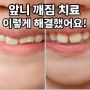 웃음치료 | 서초 우면동 도담도담키즈치과 앞니 레진 치료 후기 (가격·보험·웃음가스)
