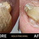 홀드핀칭 이미지