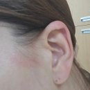 일광복지목욕탕 | 일광화상 햇볕화상 증상과 치료 후기