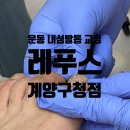 미니스톱 계양구청점 | 인천 내성발톱 통증 축구&amp;운동하는 남자 발톱교정 후기! [레푸스 계양구청점]