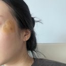 흑자제거 후기 (주관적인 흑자제거 크림, 흑자제거 패치 후기, 흑자제거 비용 등등) 이미지