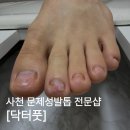 주공로 2 | 삼천포 발톱 무좀 지인의 3-4회차 관리 후기