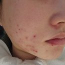 가산디지털단지역피부관리 여드름 압출이 예술인 다드림피부연구소! 5일차 후기 포함_23.03.07
