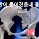 골반이 틀어졌을때 증상 이미지