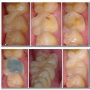 무이(Mooi) 치과기공소 | 기능교두를 포함하는 cusp capping onlay 이맥스 이건 크라운이야 온레이야?