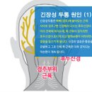 긴장형 두통 왜 이런 증상이 나타나는 것일까요? 이미지