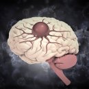 뇌종양의 ‘징조’, 두통·시력저하·기억장애…그리고? 이미지