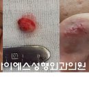 아이에스성형외과의원 네이버블로그