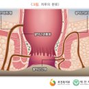 치루개 이미지