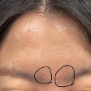 동그라미한의원 | 미간흉터 새살침 치료_이마 흉터 치료 후기 2회차 해율한의원 강남