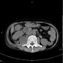 psoas muscle abscess 이미지
