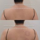 Beautyon(뷰티온) | 옥정바디관리 뷰티온 시그니처 바디 관리 후기 라운드숄더 등 어깨 통증 등살 전후 차이 디톡스 효과