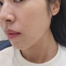 모던치과의원 | 신사역 치과 레브치과에서 받은 이갈이 보톡스 후기