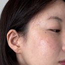 흥성섬유 | 포항피부과에서 모공피부탄력개선 위해 콜라겐레이저 레드터치프로 받아봄