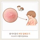 문소아과의원 | 중기 이유식 버섯 알레르기 두드러기, 7개월 아기 일요일 마포 소아과 진료 후기