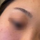 인헌제일가정의원 | 인천 이삭가정의학과 :: 3대 편평사마귀 성지 얼굴 편평사마귀 제거, 재생크림 내돈내산 후기