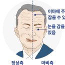 안면 신경마비[facial nerve palsy] 이미지