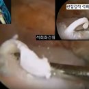 석회화건염ㆍ연관통을 아시나요 이미지