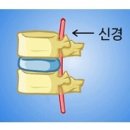 뼈와 신경을 재생하여 재발을 막아주는 자생한방병원"디스크치료한약" 이미지