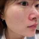 후기가 좋은데 이유가 있는 삼성역 피부과 스킨보톡스 추천 후기