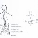 Scoliosis(척추측만증) NO. 3 이미지