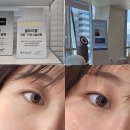 울트라콜피부과 눈밑 다크서클 고민 해결할 수 있는 울트라콜200후기