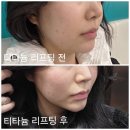 라인 | [수원 티타늄리프팅 후기] 슬림핏주사까지 받고 턱라인 살아난 후기